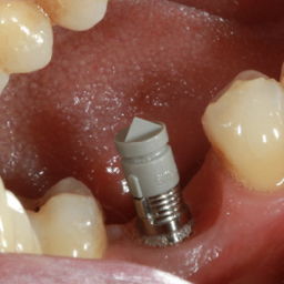 Digitally Facbricated Screw Retained Crown