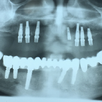 Immediate Implantation and Screw-Retained Restoration