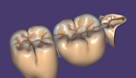 Versatile – wide range of indications for single-visit treatments